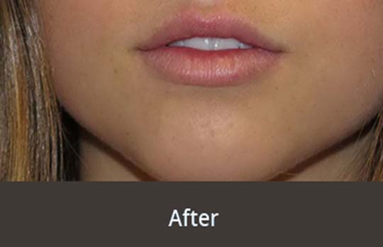 Lip Fillers 
				London Right Image